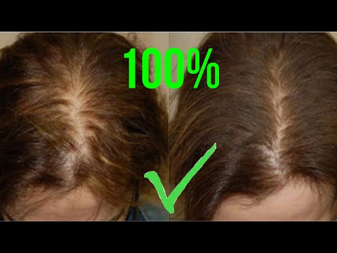 Treatment for baldness and hair loss at home. Hair grows quickly 100%