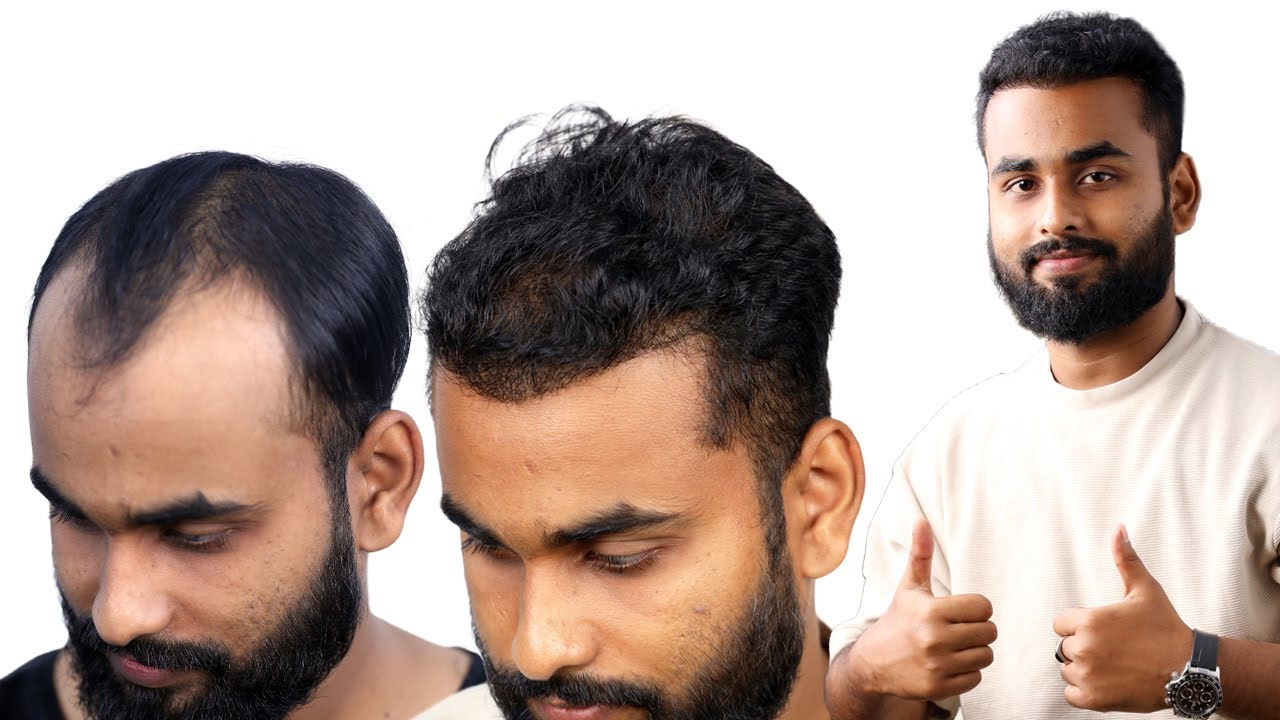 Incredible Following A Hair Transplant Hair Transplant