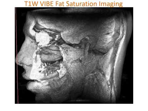 Face NeuroVasculature Mapping T1W Fat Sat