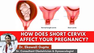How does Short Cervix affect your pregnancy ? Causes, Diagnosis \& Treatment | Healing Hospital