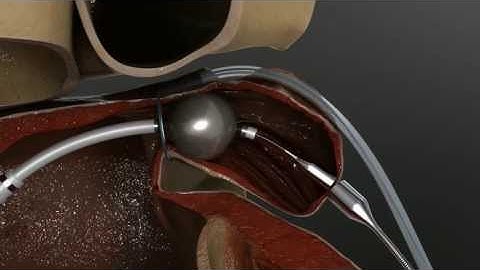 LARIAT Animation - Arrhythmia.org