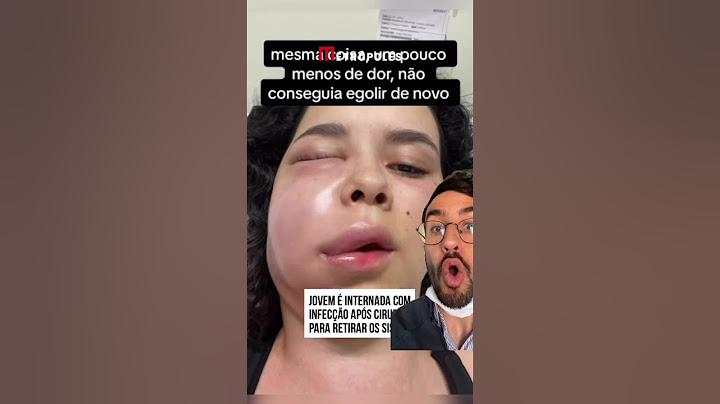 Cuidados antes e depois de fazermos a extração dos sisos. #siso #dentesiso #dente