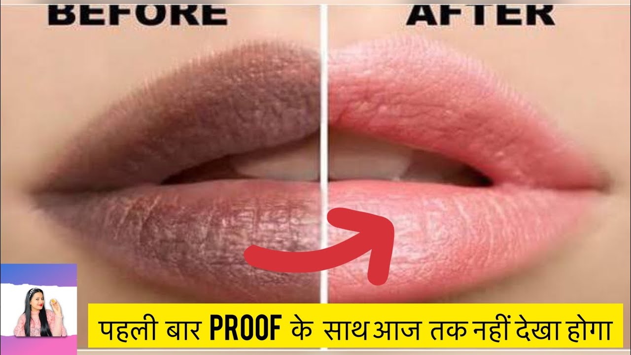 How to Get rid of Dark Lips Naturally 100 Natural 7 Easy DIY सर्दियो में Remove Dark Lips