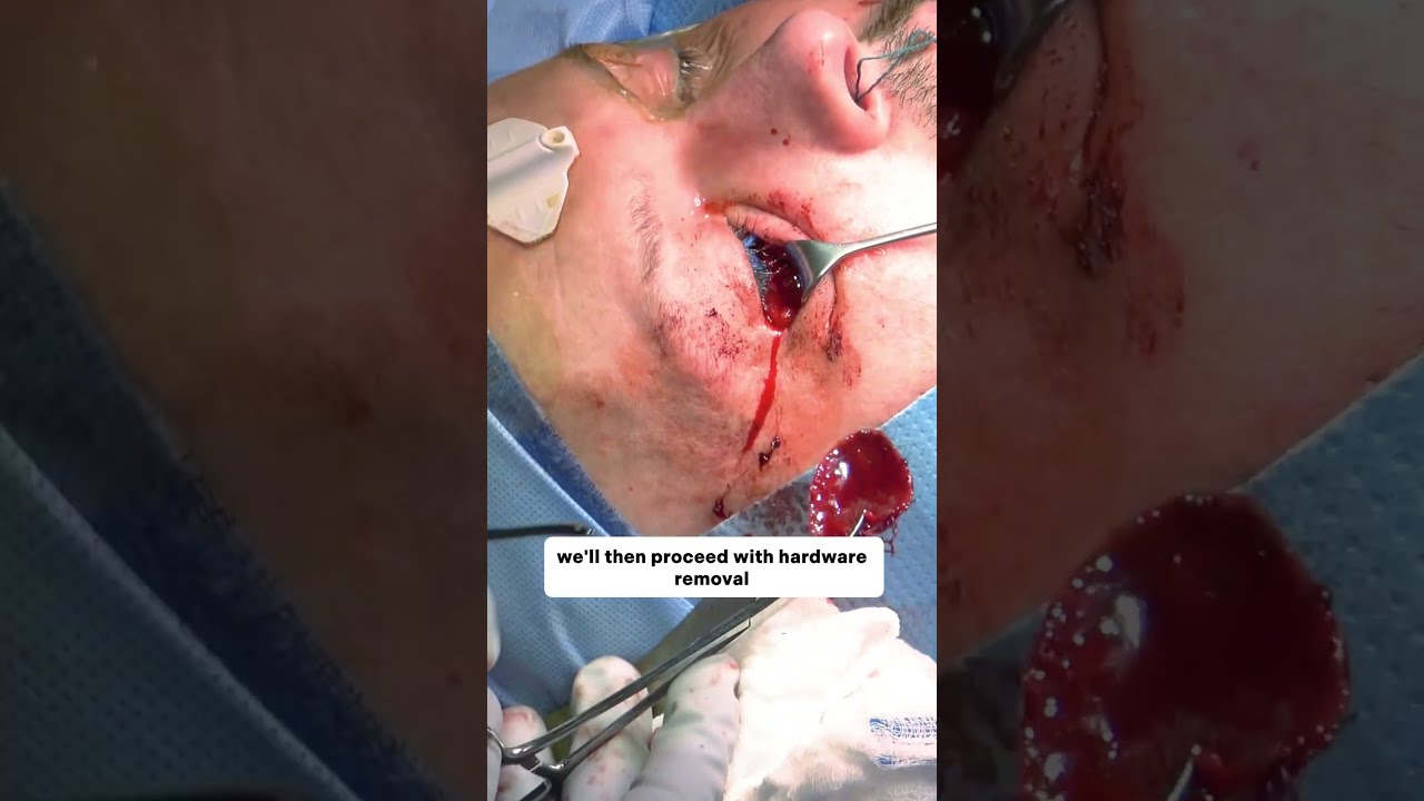 Neuronavigation and Endoscopy Pre Operative Interview with Dr. Thomas Lee #surgery #meded #jomi