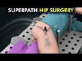 How Superpath hip replacement Surgery is Performed (3d animation)