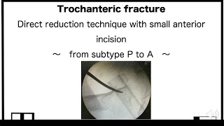 Essential And Effective Reduction Technique In Trochanteric Femur Fracture.