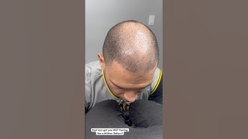 Scalp Micropigmentation Transformation | Juan Collado SMP