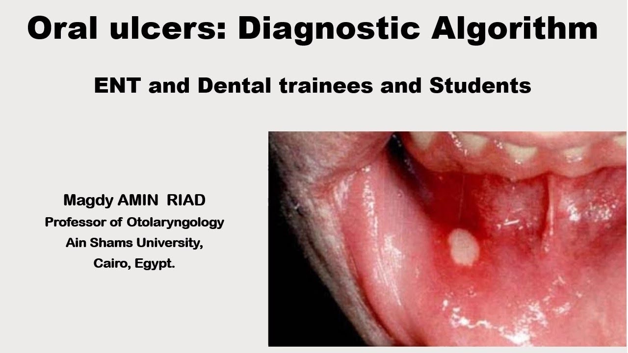Oral ulcers Diagnostic Algorithm ENT and Dental trainees and Students ...