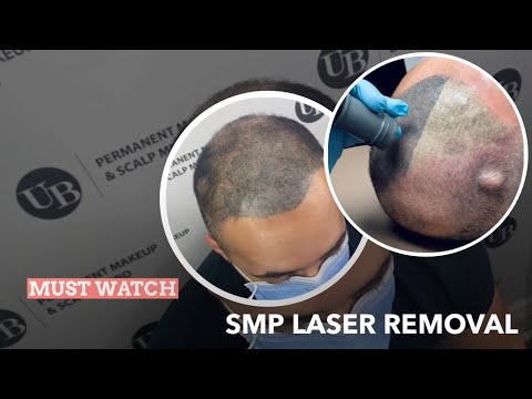 How can Scalp Micropigmentation Help with an Uneven Hairline?