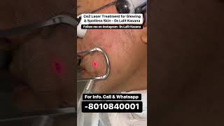 co2 laser treatment for glowing & spotless skin - Dr. Lalit Kasana