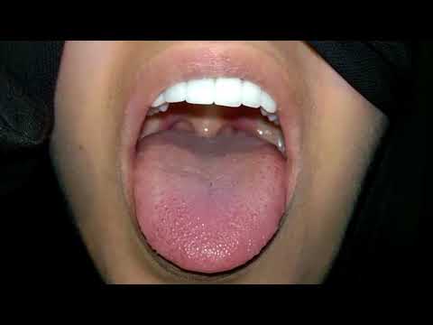 Oculopalatal Myoclonus