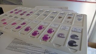 De pulmón en sangre de sangre positivo para análisis coágulo