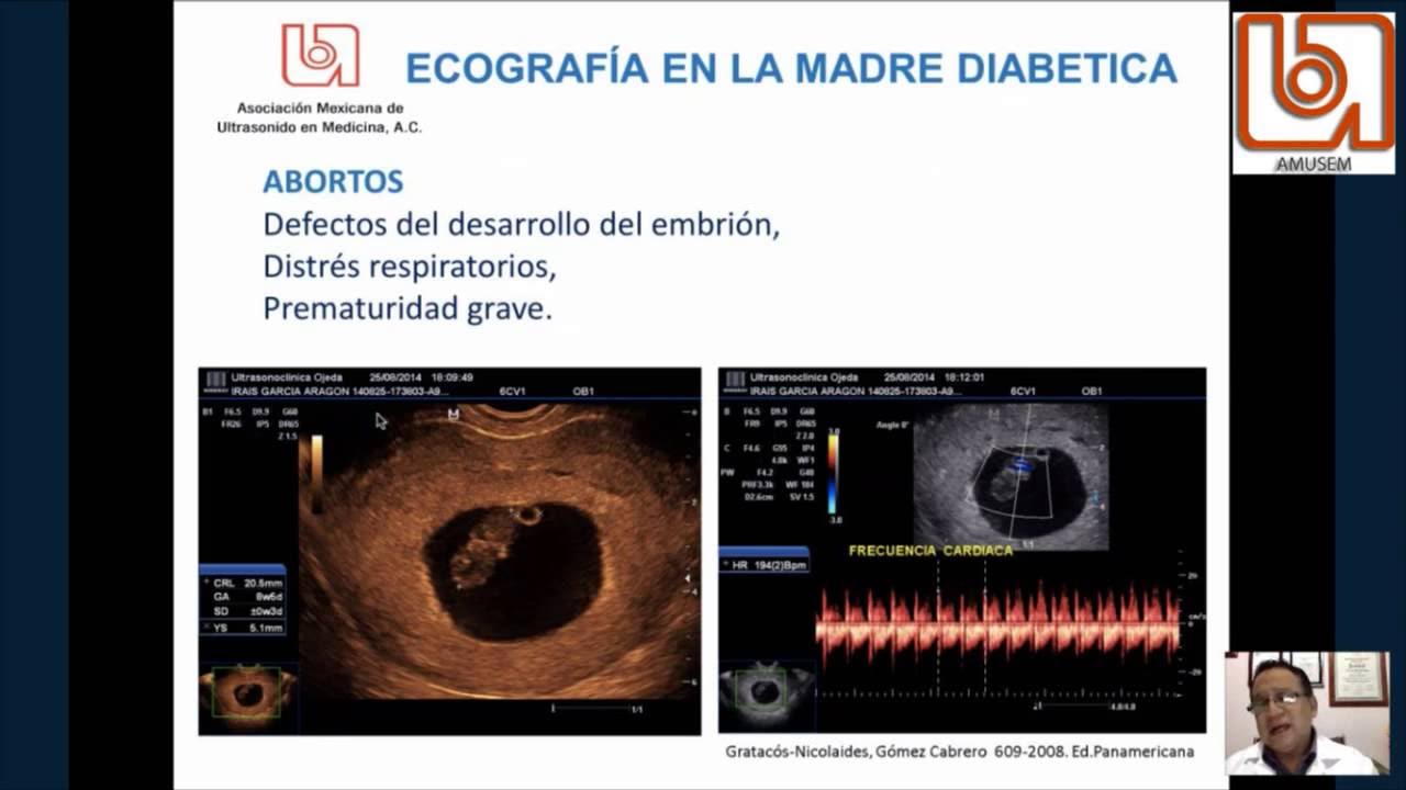 Mozart para bebes en diabetes gestacional