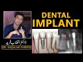 What is a dental implant   cost  procedure  problems  dr inqalab fareed  urdu  hindi