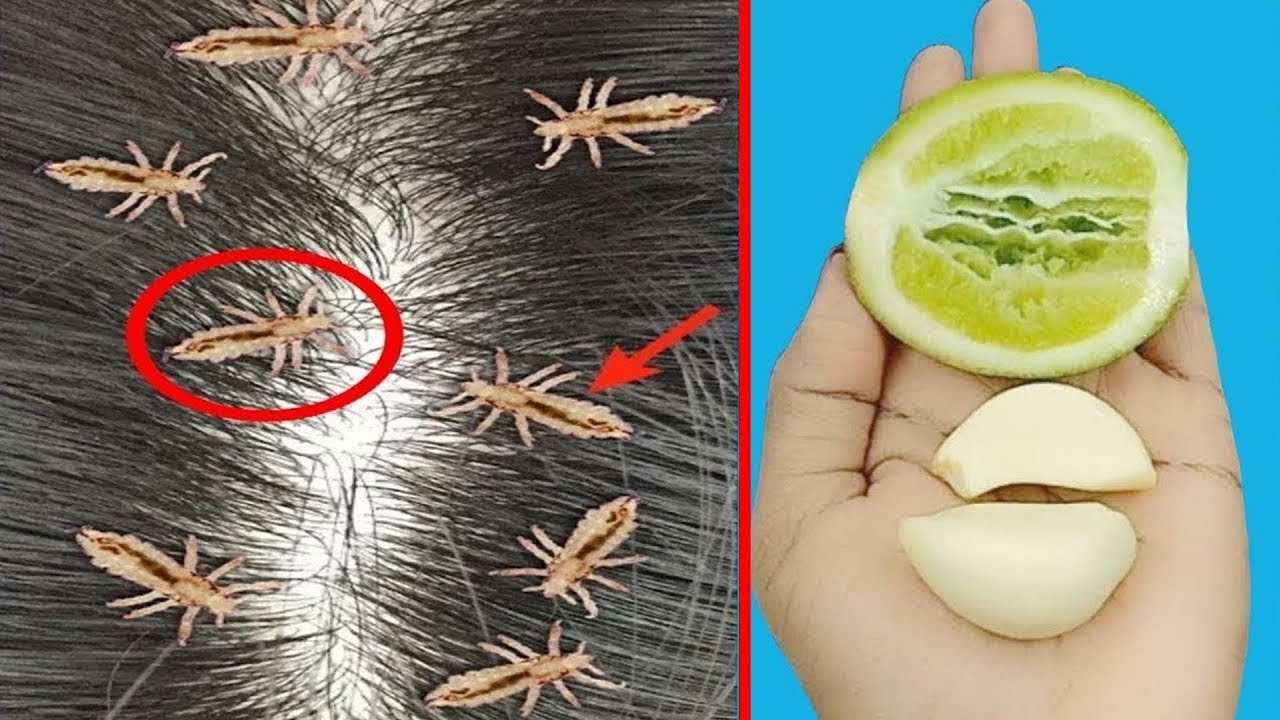 Eliminate LiceAbolish Ways To Eliminate LiceRemove Lice 100 From