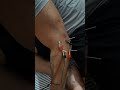 Treatment for tennis elbow injury 🏥👨⚕️ #physiotherapy #spinehealth #chiropractor