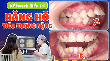 Niềng Răng Hô Nặng Kết Hợp Tiêu Xương: Phương Án Nào An Toàn Nhất, Ít Biến Chứng | Lạc Việt Intech