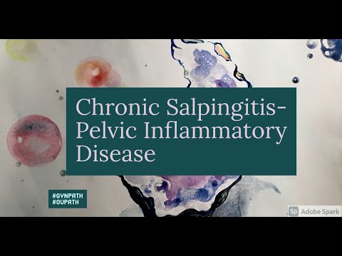 Pelvic inflammatory disease  Chronic salpingitis