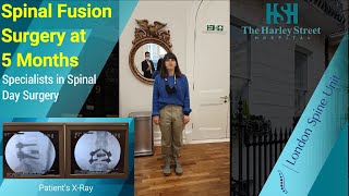Spinal Fusion Surgery at 5 Months ( London Spine Unit | Best UK Spinal Clinic )