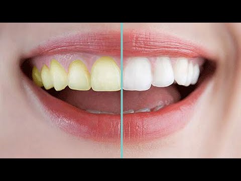 best-way-to-teeth-whiten,-get-whitening-teeth-in-3-minute,treatment-at-home