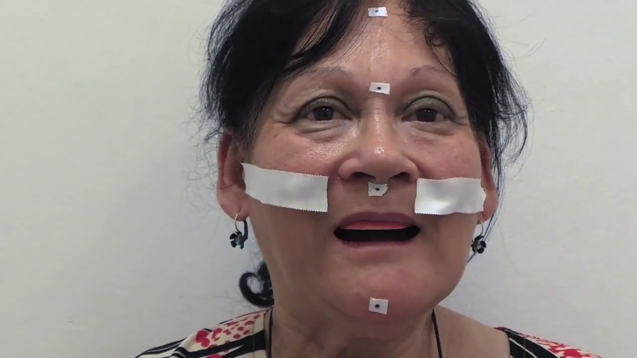 16- la relation inter maxilaire RIM - prothèse complète adjointe