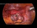 Laparoscopic right ovarian cystectomy  dr mayank jain surgeon agra