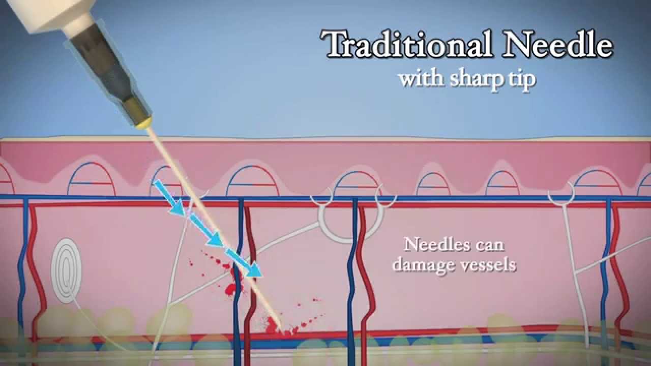 DermaSculpt MicroCannula for Facial Filler Injections - YouTube