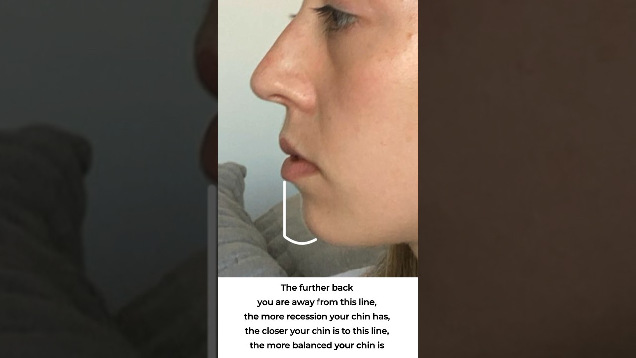 Подходите ли вы для филлеров в подбородок? 