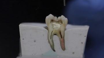 Warm Vertical Obturation Technique