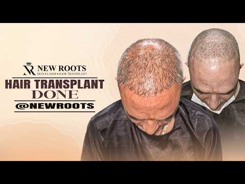 Hairline Reconstruction in Progress 🤯 | Hair Transplant in Raipur | New Roots