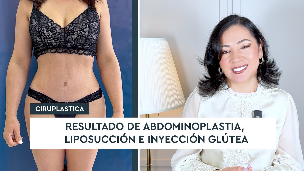 Resultado de abdominoplastia y liposucción
