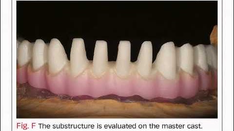 Bench Mastery: Using IPS e.max Press with a Zirconia Framework