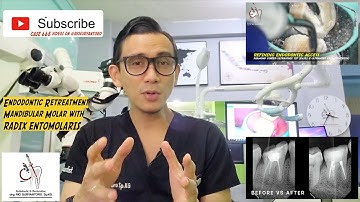 ROOT CANAL RETREATMENT IN RADIX ENTOMOLARIS ❗️ FROM REWALLING TO ACCESS CAVITY REFINEMENT ULTRASONIC