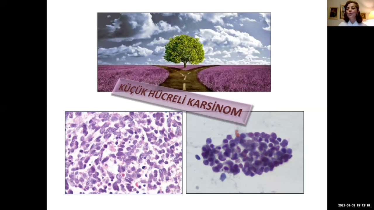 TPD - Akciğer Kanserinde Küçük Biyopsi ve Sitoloji Materyallerine Yaklaşım ve Tuzak Olgular