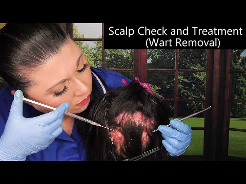 ASMR Scalp Check and Treatment (Wart Removal, Scalp Scratching, Whispering) Medical Roleplay