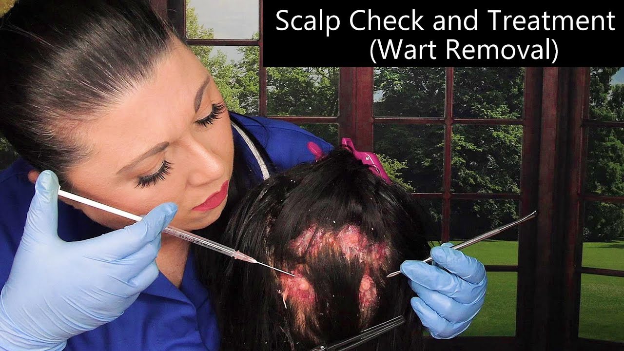 ASMR Scalp Check and Treatment (Wart Removal, Scalp Scratching
