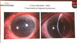 AIOC 2026   IC155   T Dr Kaushik Murali Severe Postoperative Inflammation on First Post op Day – Wha