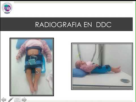 Nomenclatura actual de la displasia. Dr. César Álvarez.
