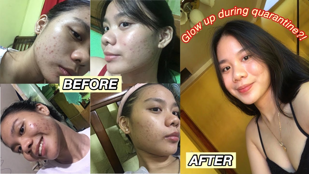 HOW I CLEARED MY ACNE AND ACNE MARKS DURING QUARANTINE + ACNE JOURNEY