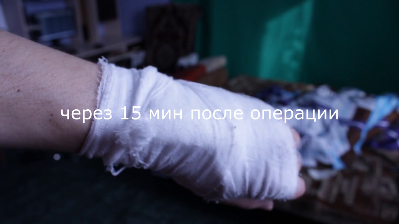 Гигрома кисти. До и После операции - YouTube