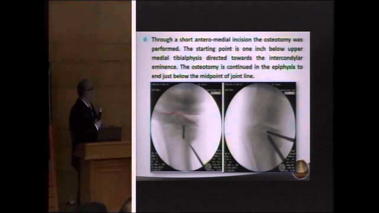 Adolescent Blount Disease