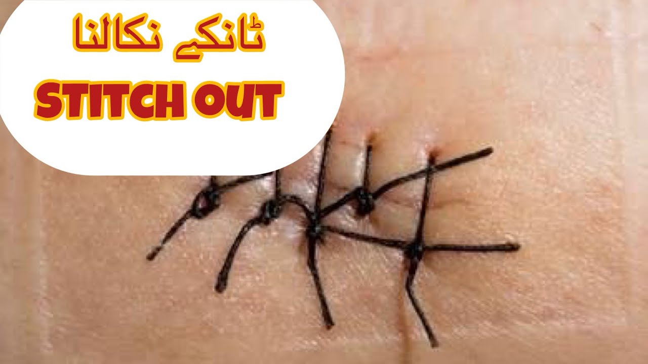 Stitch out surgical procedure YouTube