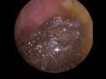 921 - Difficult Ear Wax Removal from Both Ears