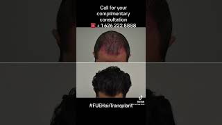 Update 18 months post FUE Hair Transplant Before &amp; After with 2500 grafts. Best Hair Transplant LA.