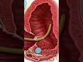 TURP Transurethral Resection Prostate - PreOp® Patient Education & Patient Engagement #shorts