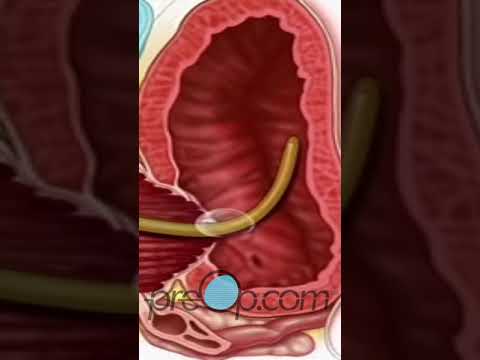 Video: Puas yog transurethral resection ntawm prostate zoo?