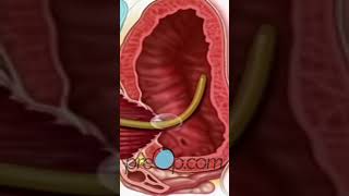 TURP Transurethral Resection Prostate - PreOp® Patient Education & Patient Engagement #shorts