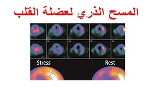 ما هو المسح الذري لعضلة القلب ؟ التصوير الاشعاعي لعضلة القلب بالمجهود و الراحة