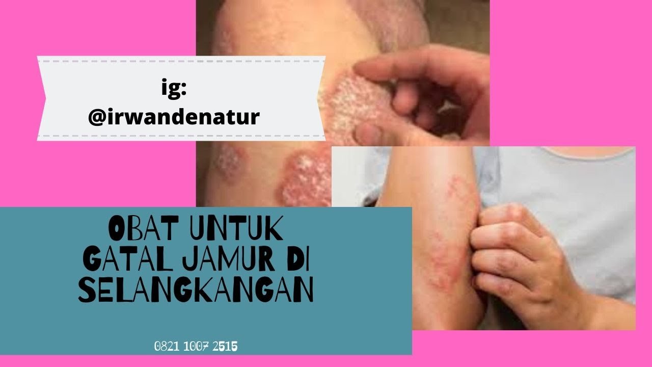 obat untuk gatal jamur di selangkangan 