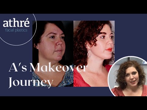 Buccal Fat Transfer, Brow Lift, Neck Lift, Eyelid Surgery: BEFORE & AFTER